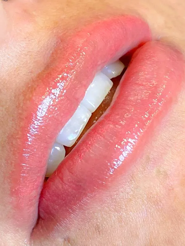 Hidra lips 