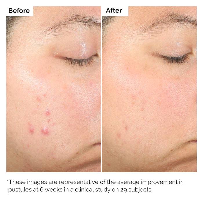 The Ordinary Salicylic Acid 2% Exfoliating Blemish Solution