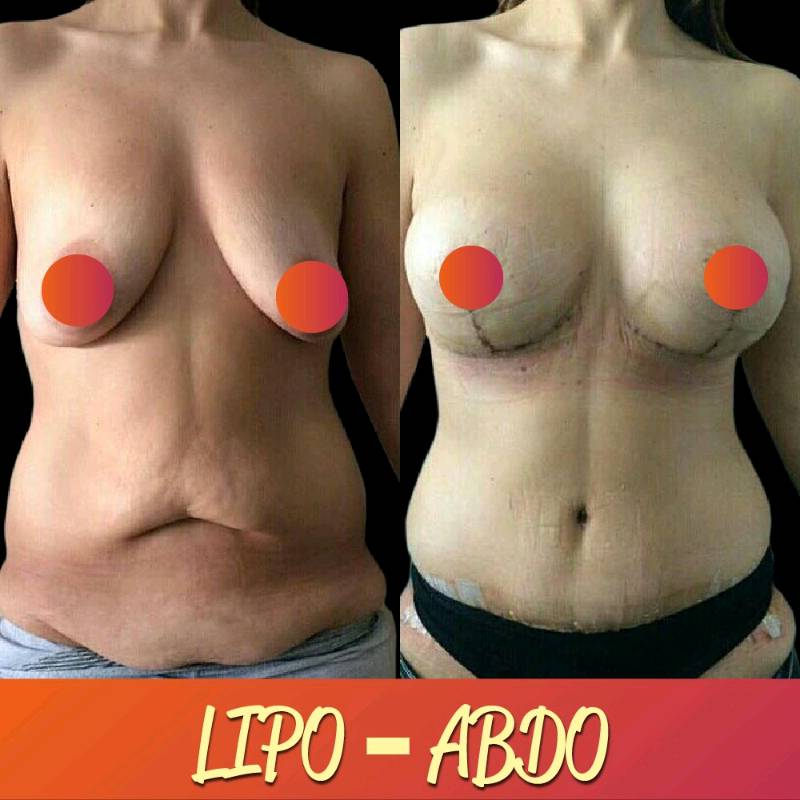 Lipo- Abdominoplastia 
