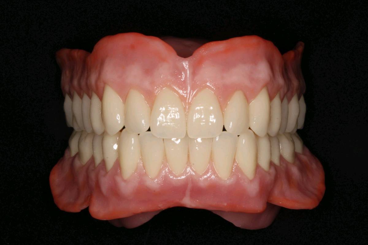 Prótesis total en acrílico de alto impacto en Santa Marta