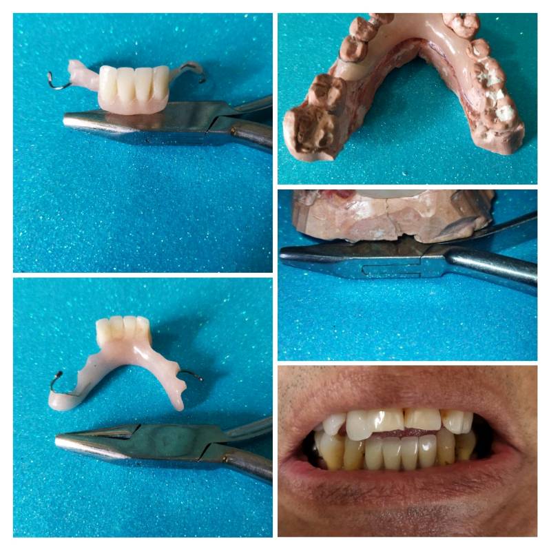 Prótesis dentales removible en acrílico en Caracas