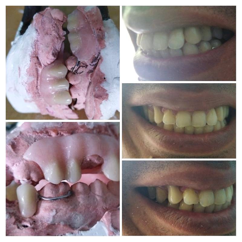 Prótesis dentales removible en acrílico en Caracas